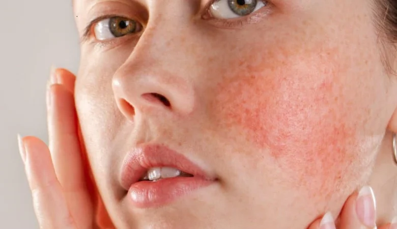 Kulit Sensitif: Kenali Ciri dan Cara Perawatannya